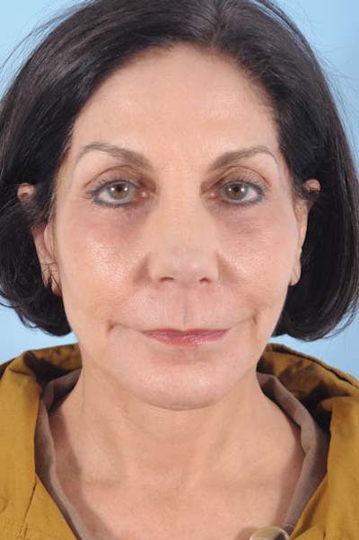 Facelift Before & After Gallery - Patient 110505 - Image 2