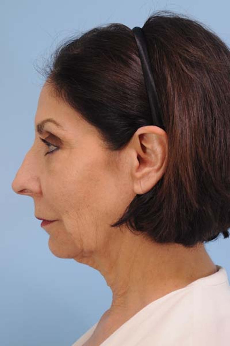 Facelift Before & After Gallery - Patient 110505 - Image 3
