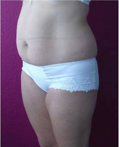 Ultrashape Before & After Gallery - Patient 375917 - Image 1