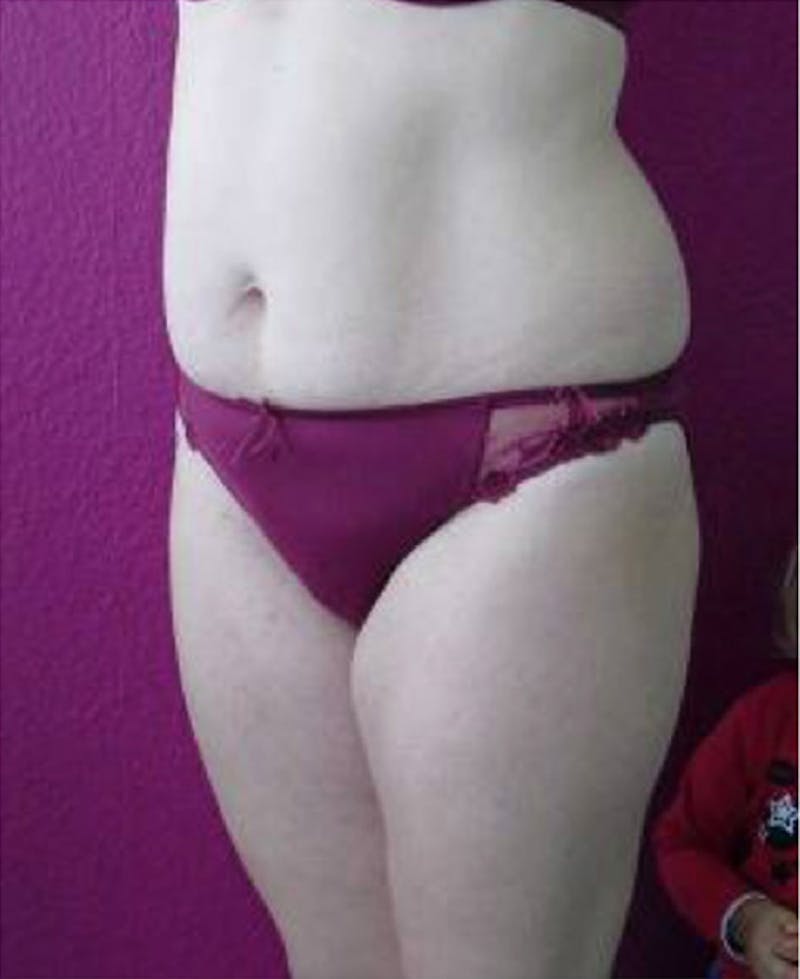 Ultrashape Before & After Gallery - Patient 375917 - Image 2
