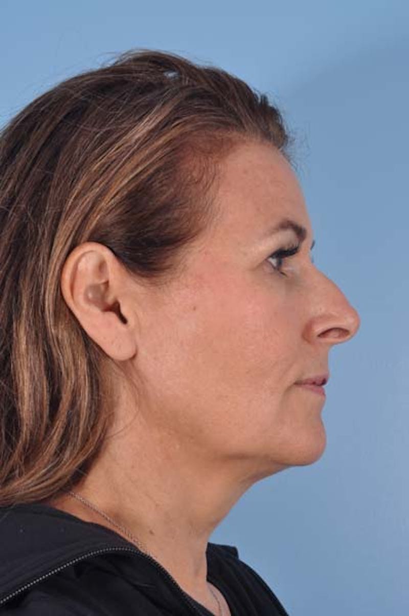 Facelift Before & After Gallery - Patient 868317 - Image 5
