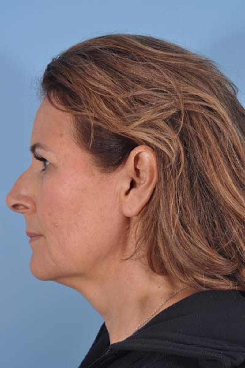 Facelift Before & After Gallery - Patient 868317 - Image 7