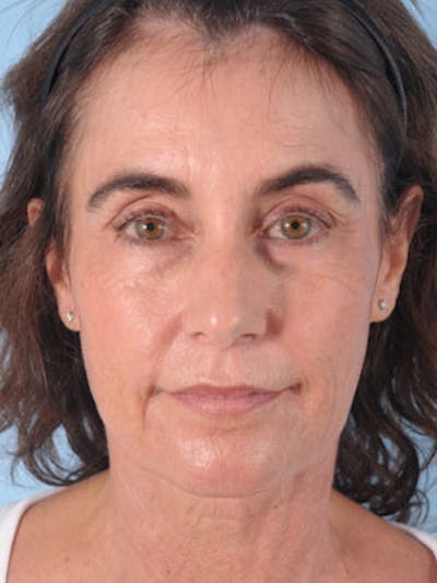 Facelift Before & After Gallery - Patient 349681 - Image 1
