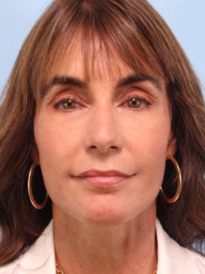 Lower Blepharoplasty Before & After Gallery - Patient 386695 - Image 2