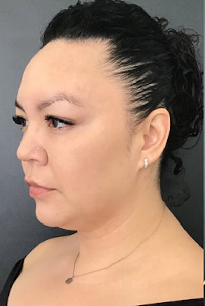 Ultherapy Before & After Gallery - Patient 319707 - Image 1