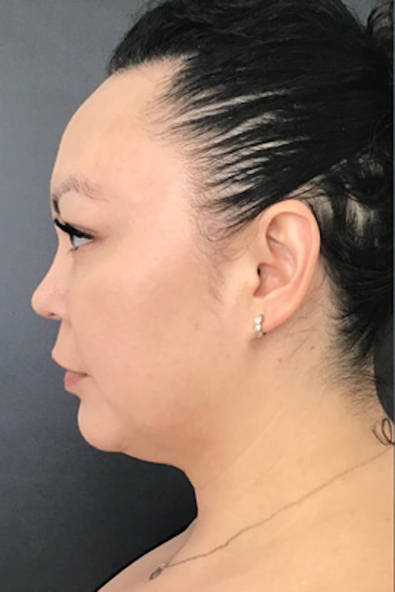 Ultherapy Before & After Gallery - Patient 319707 - Image 3