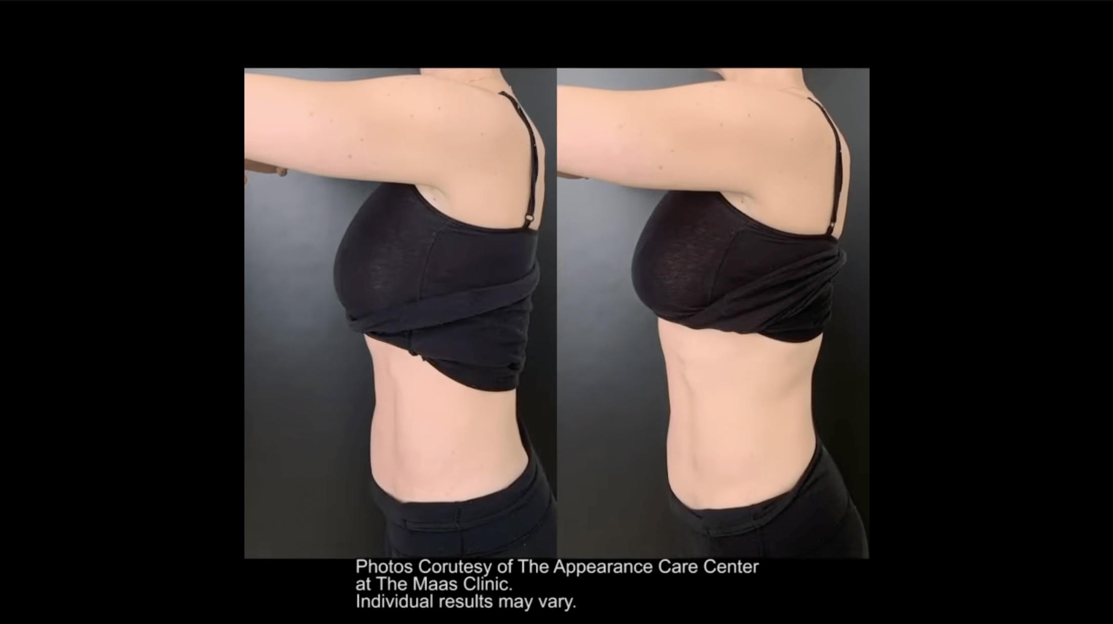 before and after of a womans stomach