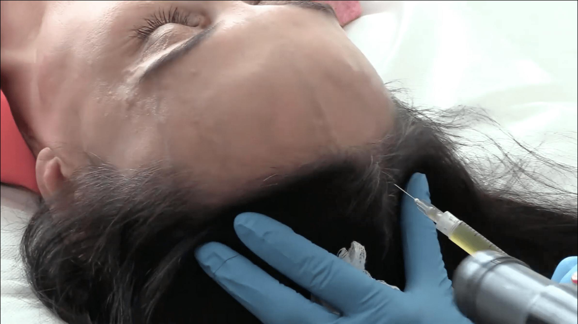 close up of an injection going into someones hair