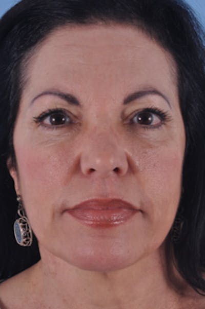 Upper Blepharoplasty Before & After Gallery - Patient 245452 - Image 2