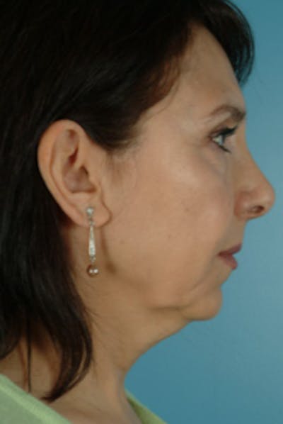 Chin Implant Before & After Gallery - Patient 245037 - Image 1