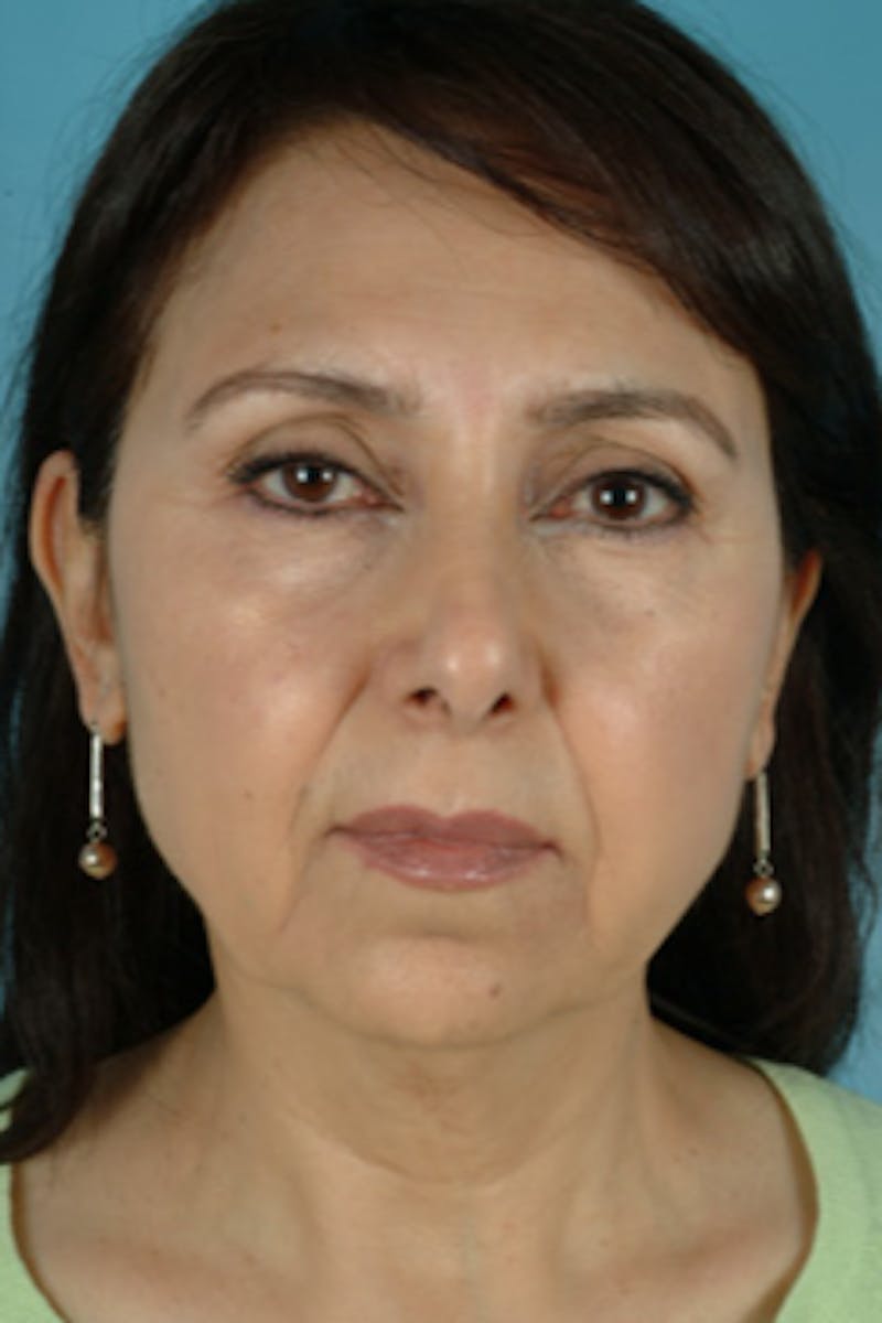 Chin Implant Before & After Gallery - Patient 245037 - Image 3