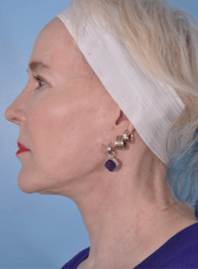 Neck Lift Before & After Gallery - Patient 159014 - Image 2
