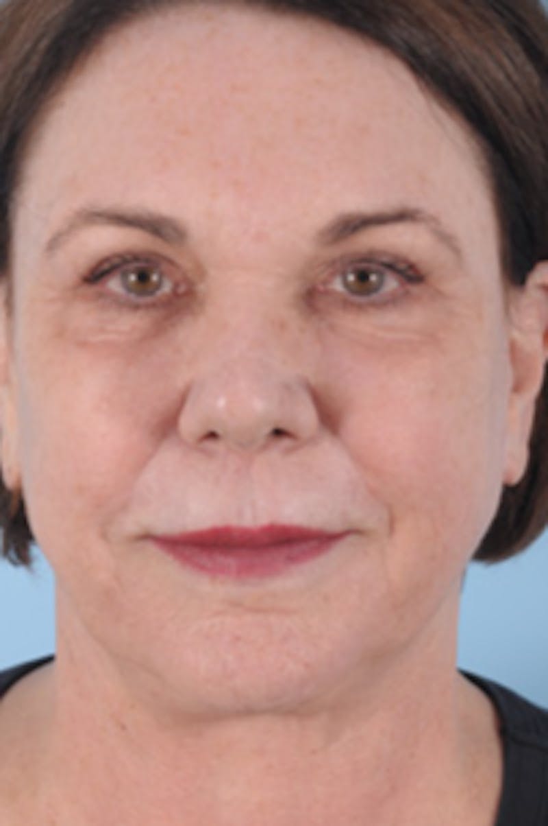 Neck Lift Before & After Gallery - Patient 430517 - Image 2