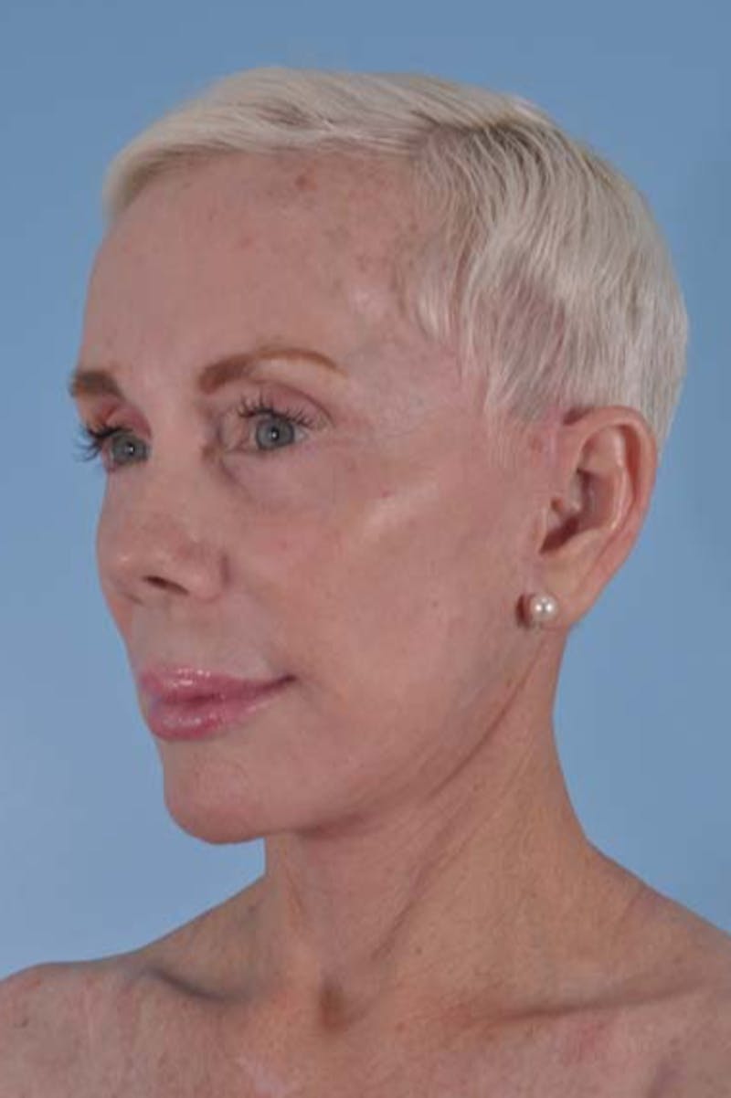 Neck Lift Before & After Gallery - Patient 278174 - Image 6