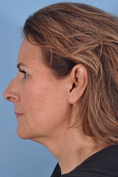 Neck Lift Before & After Gallery - Patient 421465 - Image 1