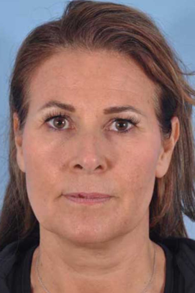 Neck Lift Before & After Gallery - Patient 421465 - Image 3