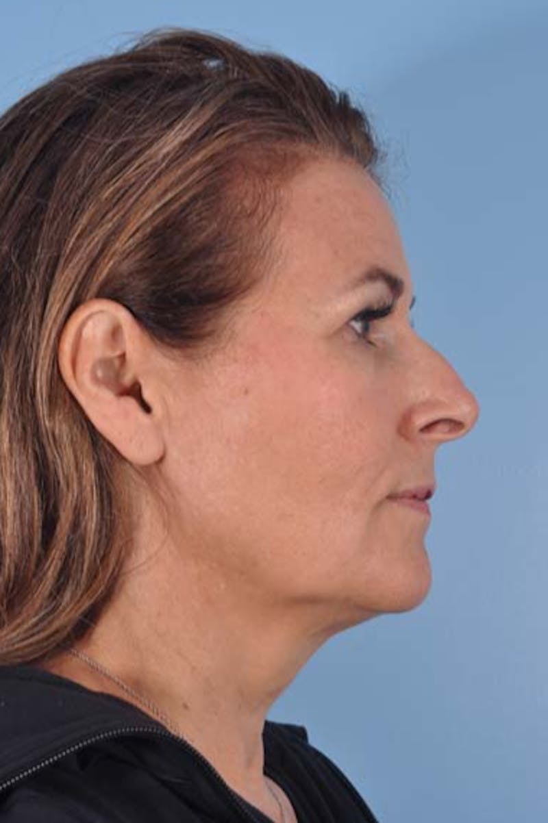 Neck Lift Before & After Gallery - Patient 421465 - Image 7