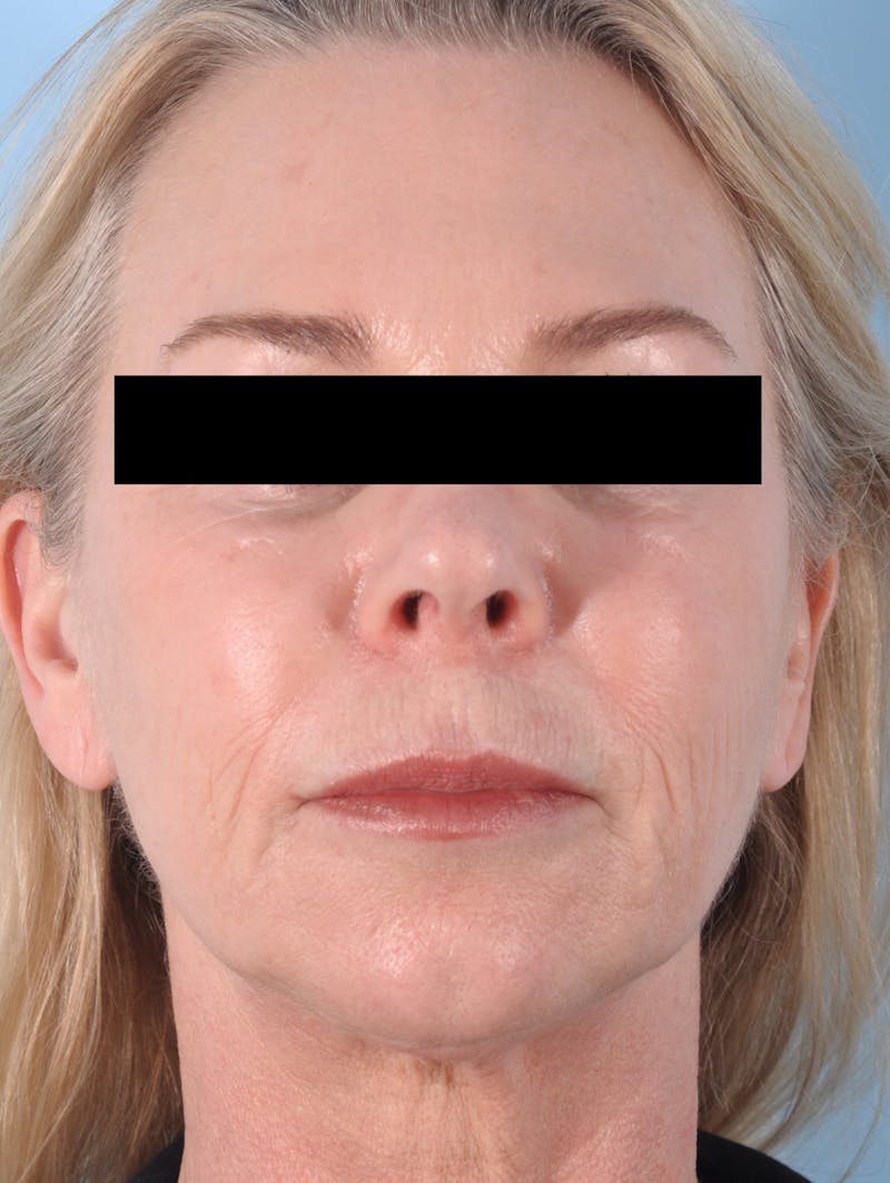 Facelift Before & After Gallery - Patient 154257 - Image 1
