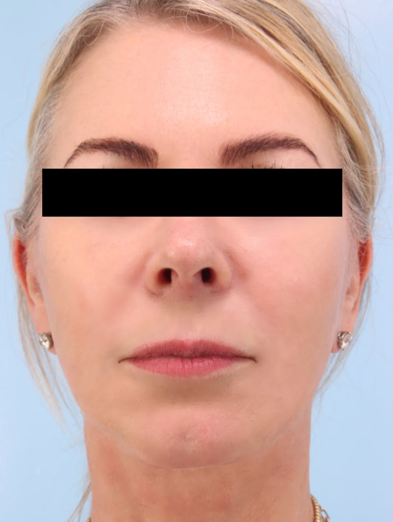 Facial Resurfacing Before & After Gallery - Patient 423889 - Image 2