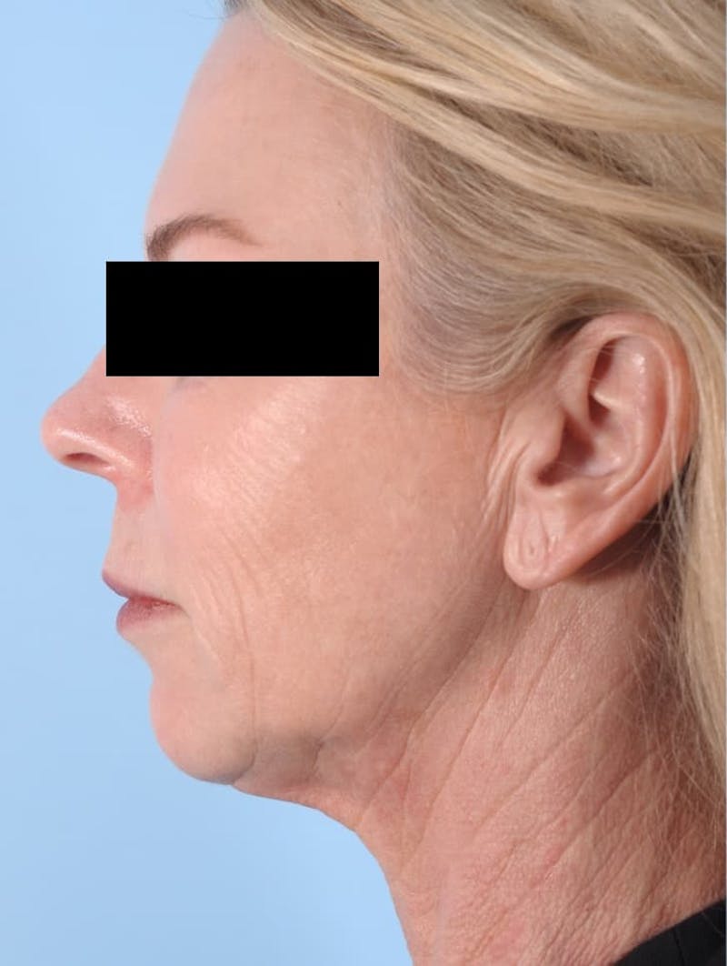 Facelift Before & After Gallery - Patient 154257 - Image 3
