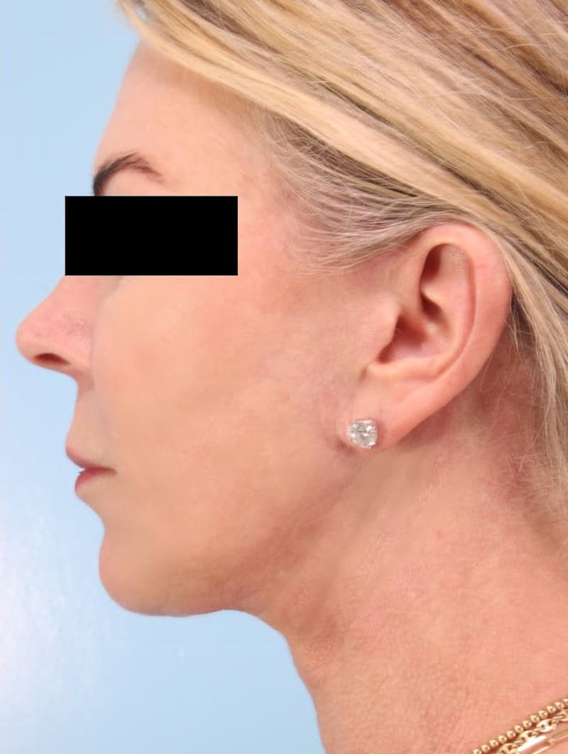 Facial Resurfacing Before & After Gallery - Patient 423889 - Image 4
