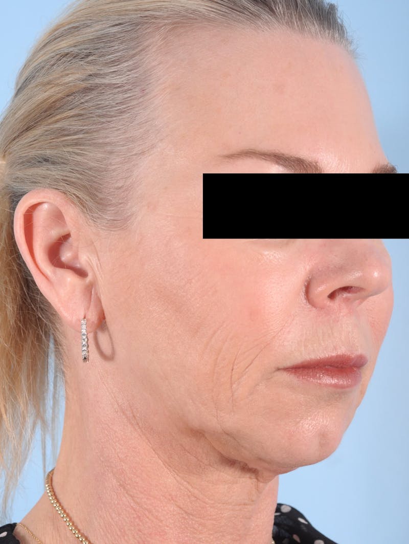 Facelift Before & After Gallery - Patient 154257 - Image 5