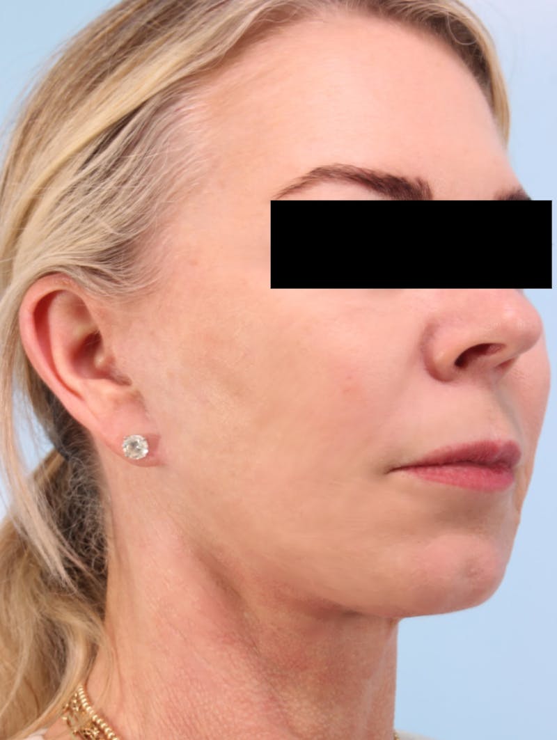 Facelift Before & After Gallery - Patient 154257 - Image 6
