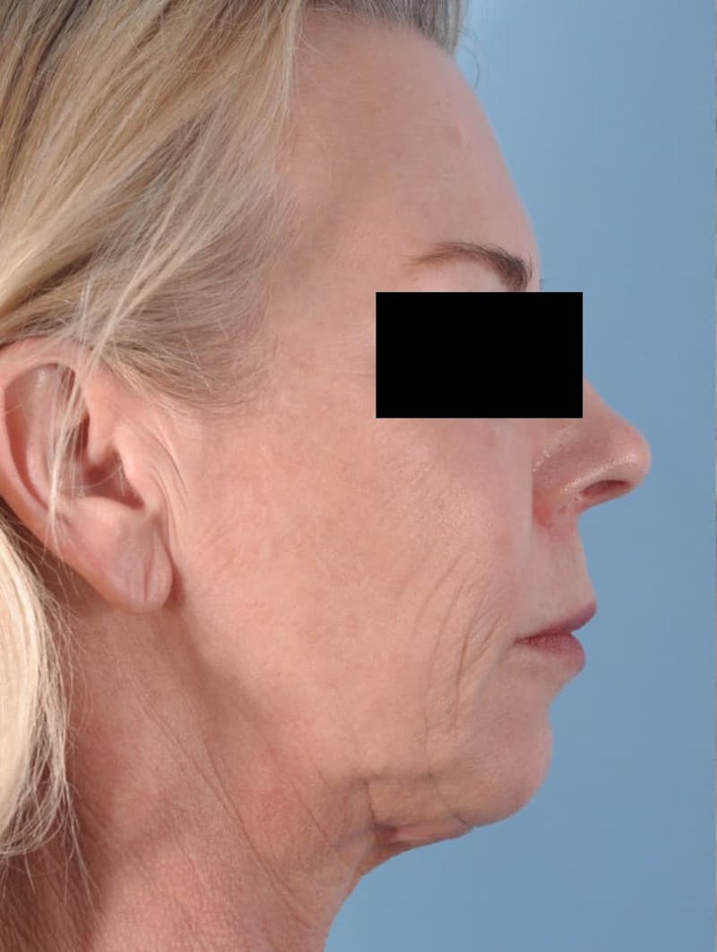 Facial Resurfacing Before & After Gallery - Patient 423889 - Image 7