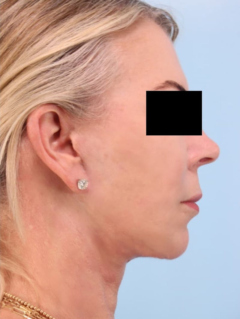 Facial Resurfacing Before & After Gallery - Patient 423889 - Image 8