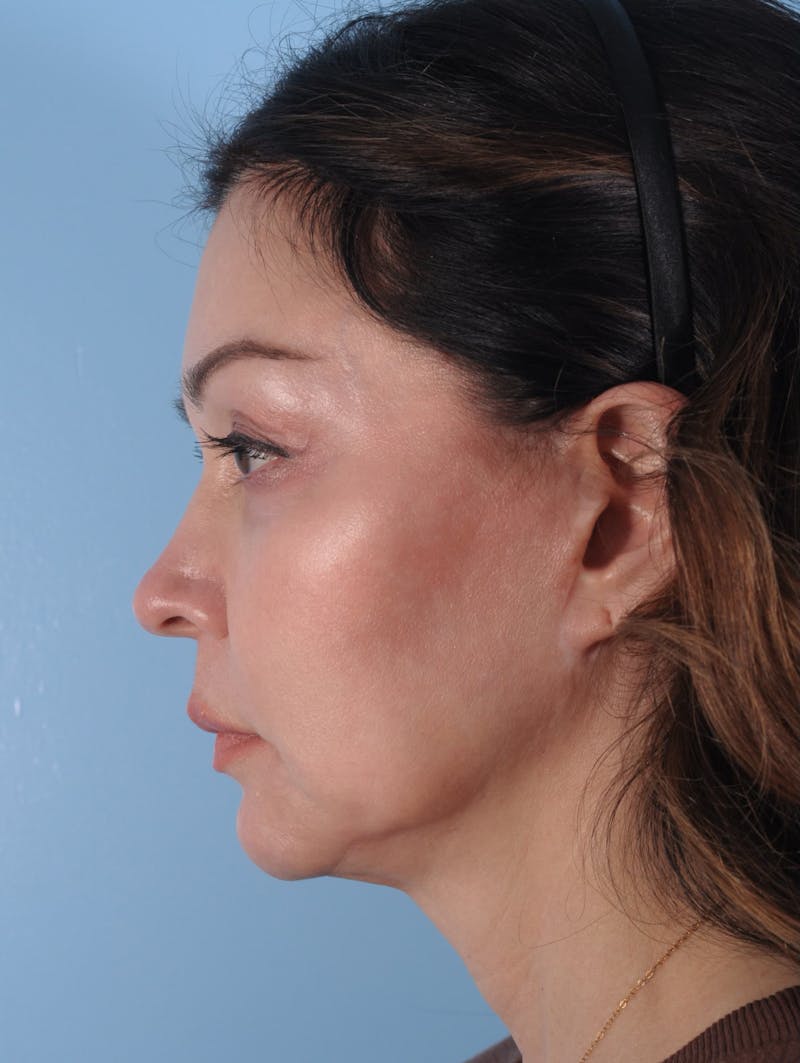 Facelift Before & After Gallery - Patient 401877 - Image 3