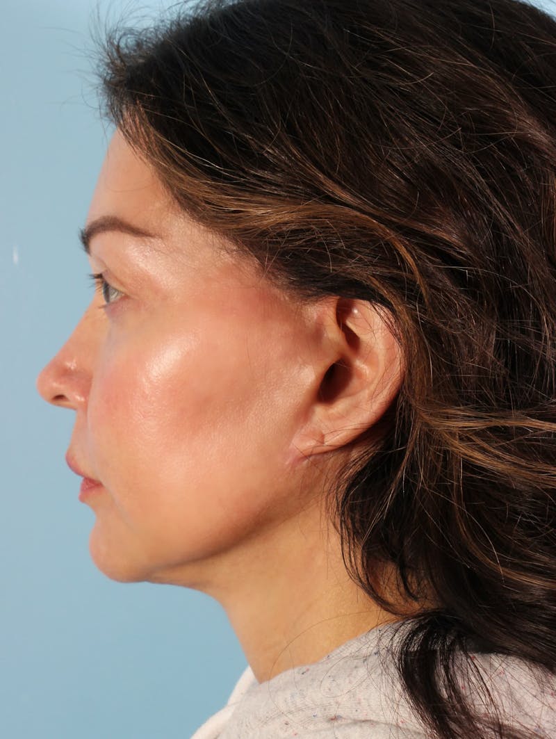 Fat Transfer Before & After Gallery - Patient 394612 - Image 4