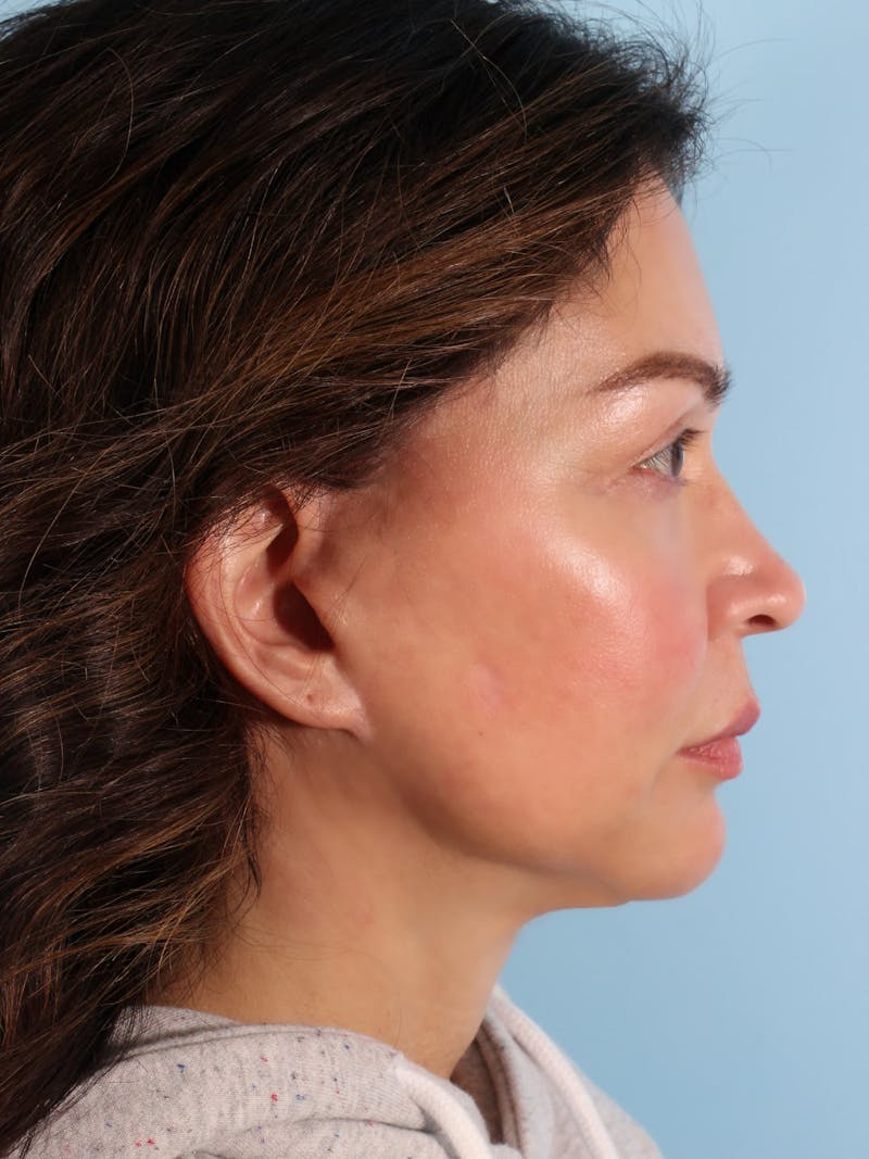 Fat Transfer Before & After Gallery - Patient 394612 - Image 6