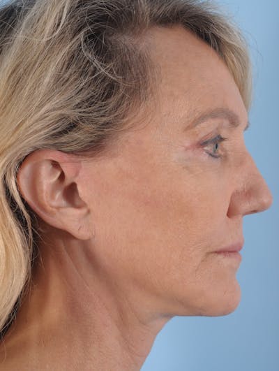 Facelift Before & After Gallery - Patient 318330 - Image 2