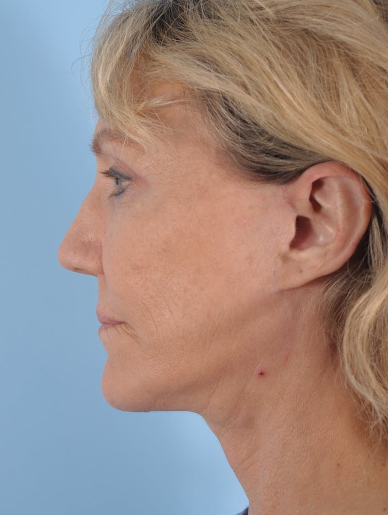 Facelift Before & After Gallery - Patient 318330 - Image 4