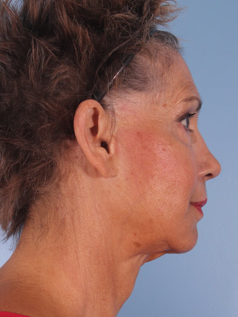 Facelift Surgery  Before & After Gallery - Patient 380325 - Image 3