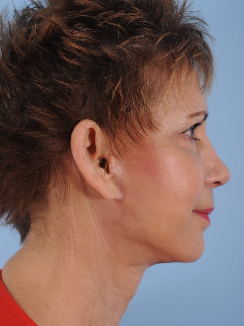 Facelift Before & After Gallery - Patient 380325 - Image 4
