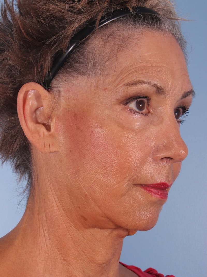 Facelift Surgery  Before & After Gallery - Patient 380325 - Image 5