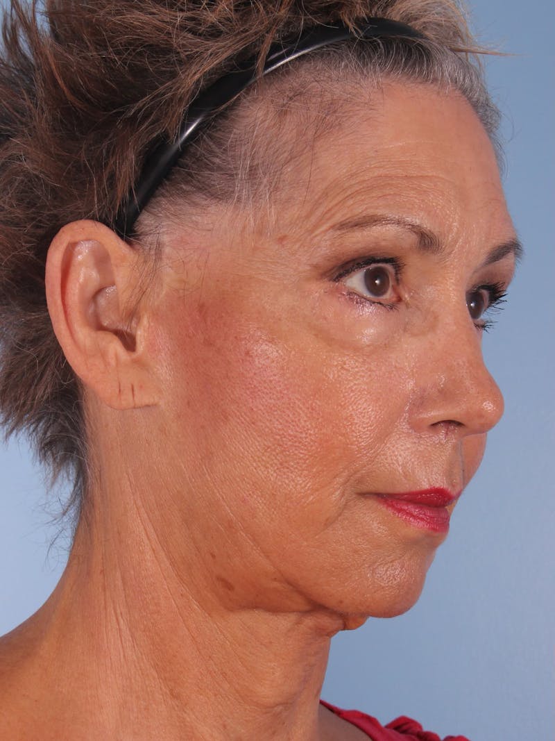 Facelift Before & After Gallery - Patient 380325 - Image 5