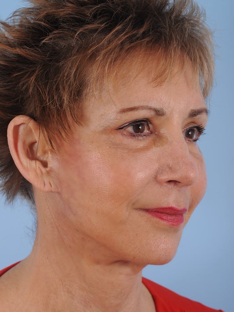 Facelift Surgery  Before & After Gallery - Patient 380325 - Image 6