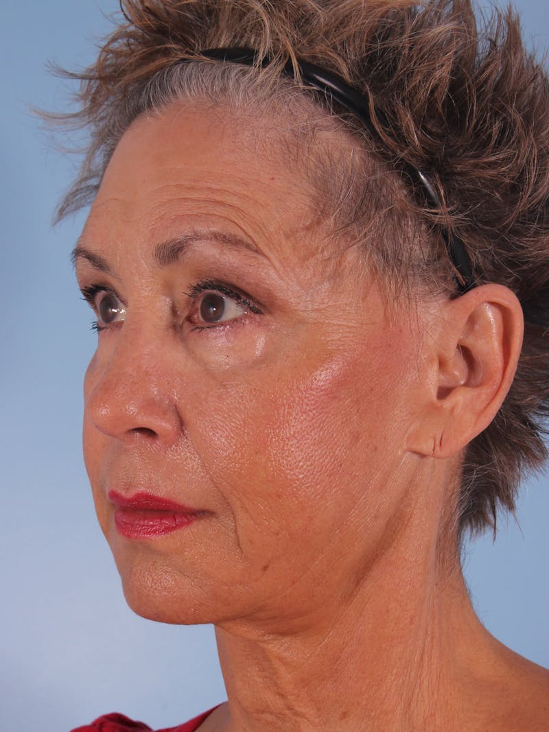 Facelift Surgery  Before & After Gallery - Patient 380325 - Image 7