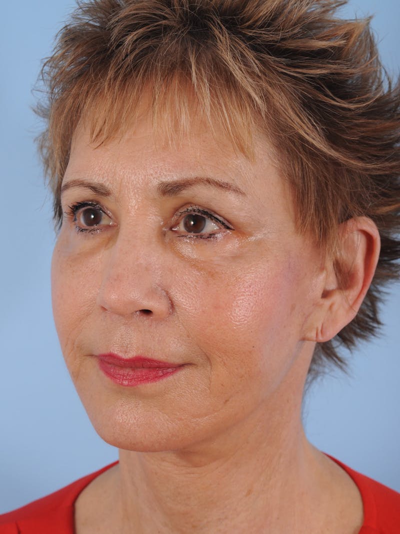 Facelift Surgery  Before & After Gallery - Patient 380325 - Image 8