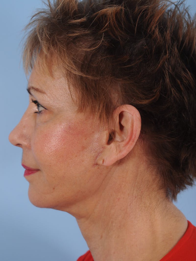 Facelift Surgery  Before & After Gallery - Patient 380325 - Image 10