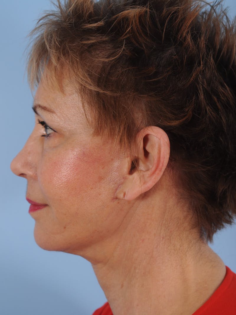 Facelift Before & After Gallery - Patient 380325 - Image 10