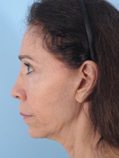 Facelift Before & After Gallery - Patient 208013 - Image 1