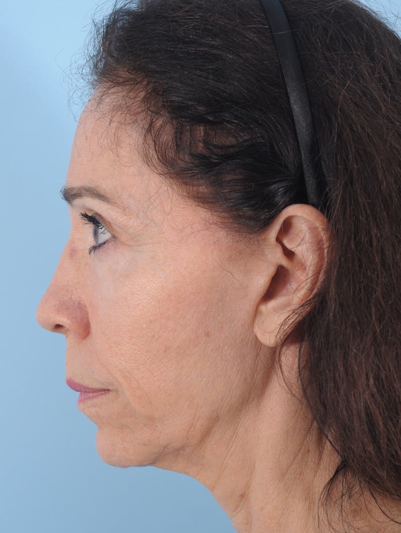 Facelift Before & After Gallery - Patient 208013 - Image 1