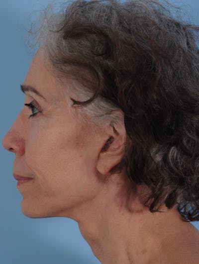 Facelift Before & After Gallery - Patient 208013 - Image 2