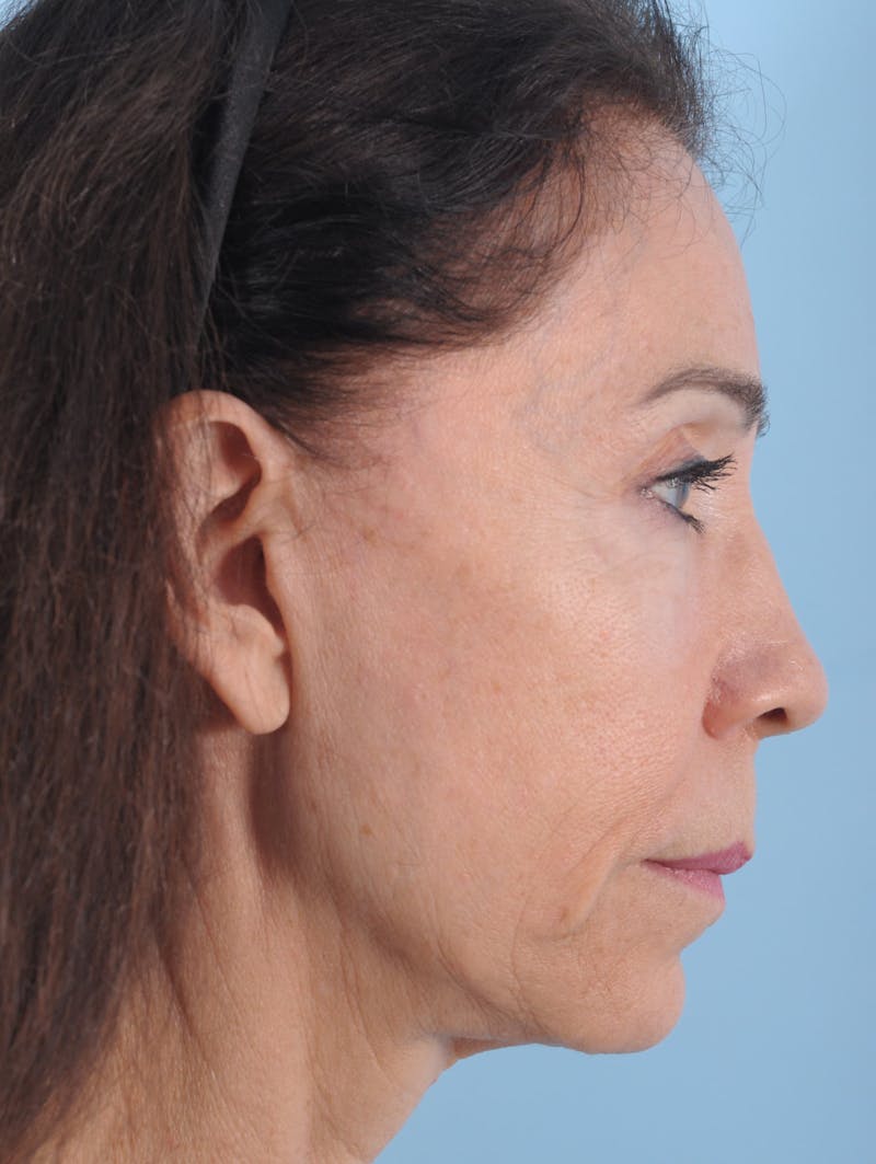 Facelift Before & After Gallery - Patient 208013 - Image 3
