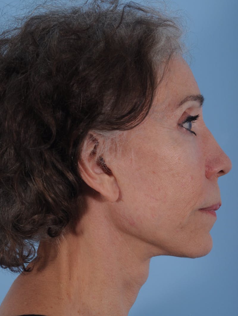 Facelift Before & After Gallery - Patient 208013 - Image 4