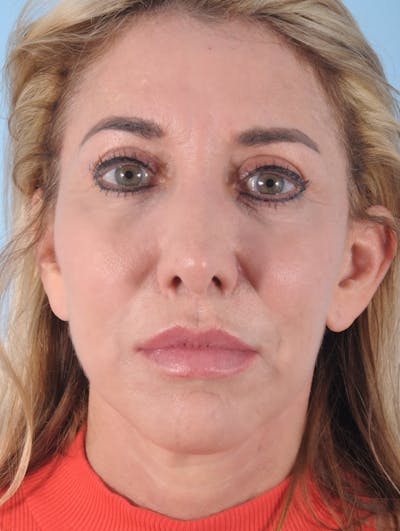 Lip Lift / Implants Before & After Gallery - Patient 616113 - Image 2