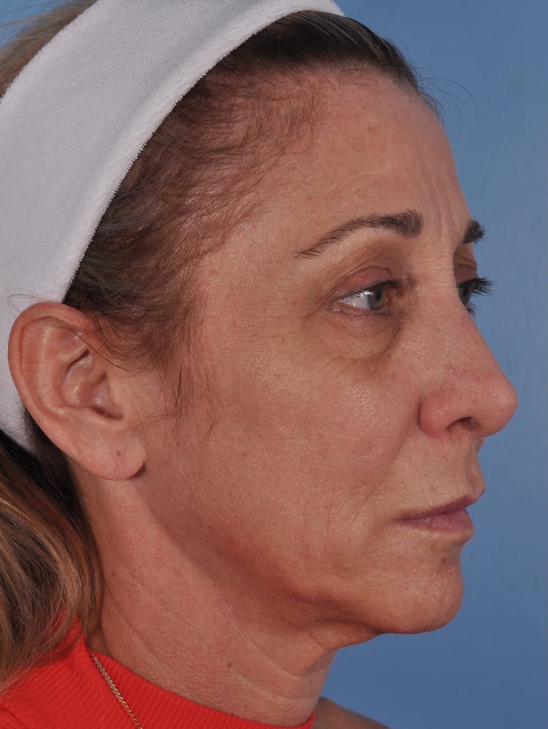 Facelift Before & After Gallery - Patient 813799 - Image 3